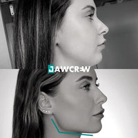 mâchoire carrée femme avant après